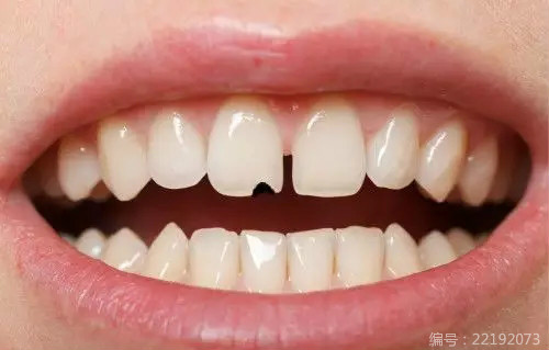 牙齿稀疏是什么原因
