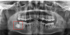 牙医访谈录 09 | 埋伏在口腔里的「地雷」，必须要除之而后快